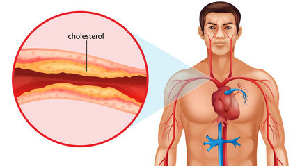 Ateriosclerosis